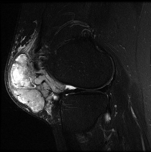 Figure 3 for case synovial sarcoma ( RID4558 )